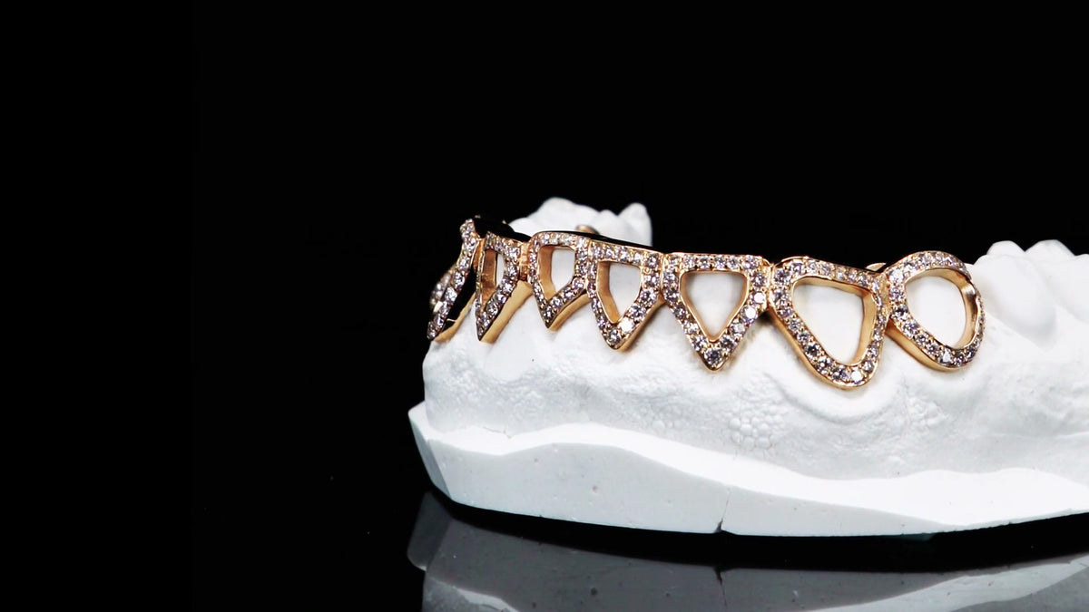 Grillz auf Gipsmodell